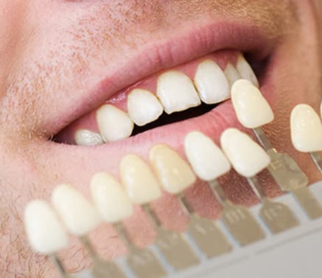 Teeth whitening