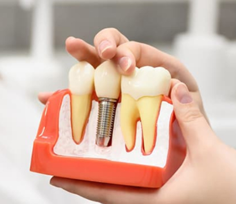 Dental Implant
